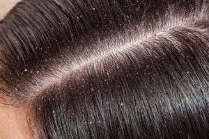 How to get rid of dandruff in winter