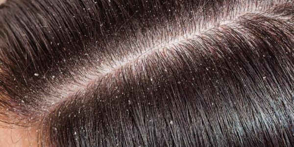How to get rid of dandruff in winter